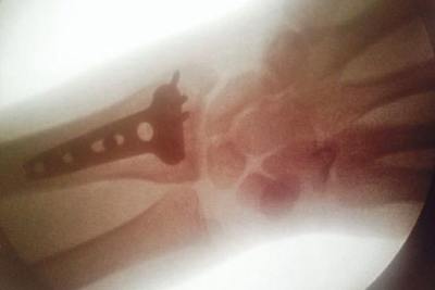 Der linke Unterarm von Tommy Searle wurde operiert