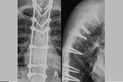 Das Röntgenbild von Tonkovs verletzter Wirbelsäule