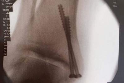 Der Bruch in Efren Vazquez Knöchel wurde nun mit zwei Schrauben fixiert