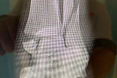 Der Bruch im linken Bein vor