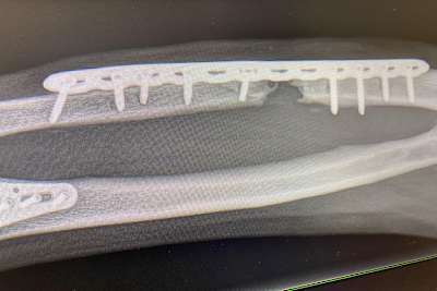 Auf dem Röntgenbild ist die Fehlstelle im Unterarmknochen deutlich zu sehen