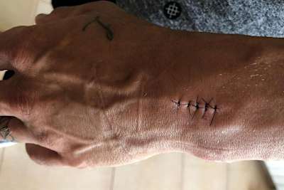 Fünf Tage vor dem Rennen wurde Crutchlow operiert