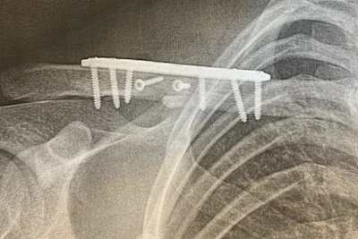 Das Schlüsselbein von Isak Gifting wurde mit Metallplatten und Schrauben fixiert