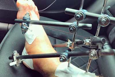 Stichs Fuss in Einzelteilen