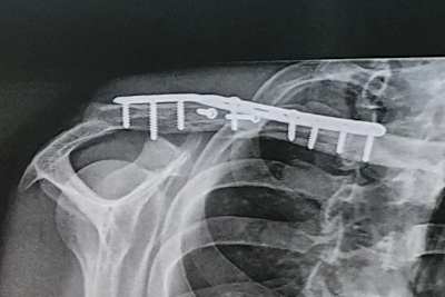 Das zertrümmerte Schlüsselbein nach der OP