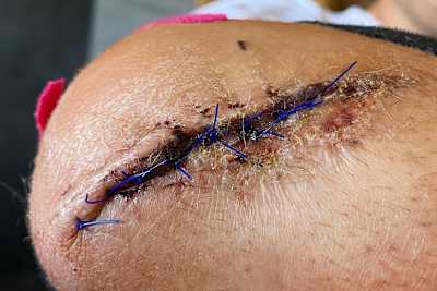 Kein Halloween, sondern Patrick Hobelsbergers Ellbogen