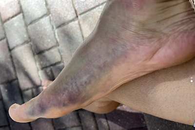 Ken Roczen zeigte die Folgen seines Sturzes in Abu Dhabi