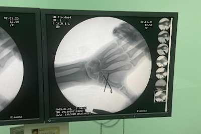 Die rechte Hand von Deniz Öncü: Der Bruch wurde operativ fixiert