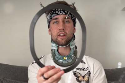 Marcel Stauffer: Nach 12 Wochen durfte der Fixateur weg.