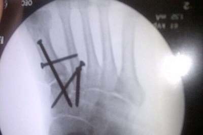 Kenan Sofuoglus rechter Fuss