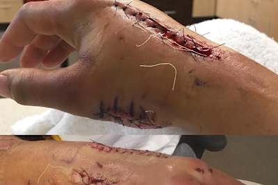 Ken Roczens rechte Hand wurde übel lädiert