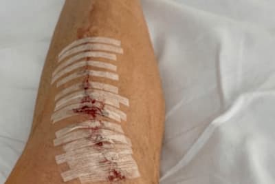 Jack Millers operiertes Schienbein