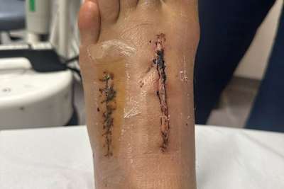 Die Ärzte hatten in Johnny Reas Fuß viel zu reparieren