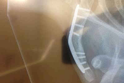 Tai Woffinden: Metallplatte verbogen, Schlüsselbein erneut gebrochen