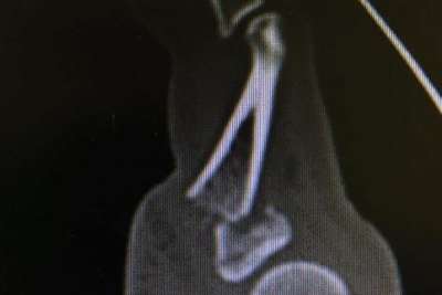 Der veschobene Bruch am kleinen Finger sieht schmerzhaft aus