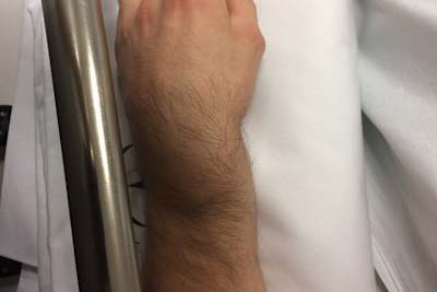 So sah der Unterarm von Eugene Laverty vor der Operation am Freitag aus