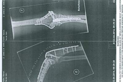 Drei Metallplatten und 20 Schrauben waren nötig, um den Arm zu richten
