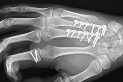 Die lädierte Hand von Domi Schmitter