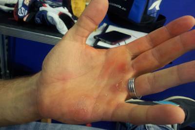 Beide Hände von Sylvain Guintoli zieren fette Blasen