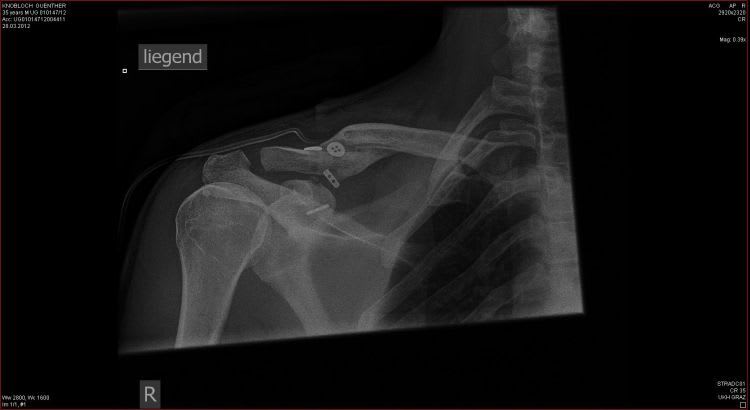 Knoblochs Schulter von innen