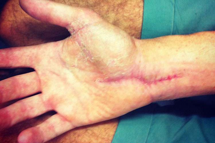 Die Hand von Alexander Lundh