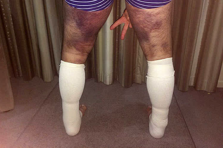 Die Spuren vom Sturz sind noch deutlich sichtbar