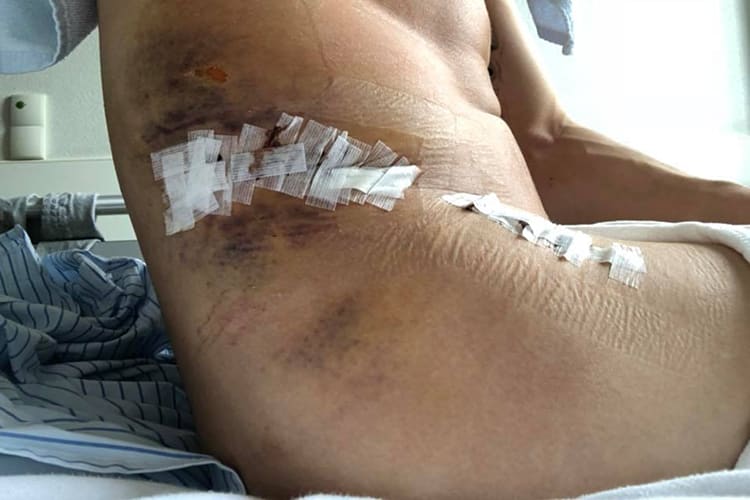 So sieht Dominique Aegerters Hüfte nach seiner Operation aus