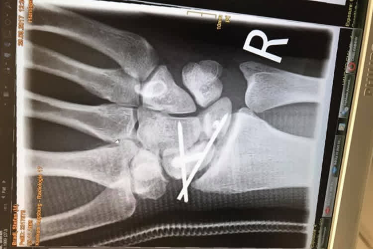 Stefan Bradls rechte Hand: Zwei Stifte und ein Draht wurden eingesetzt