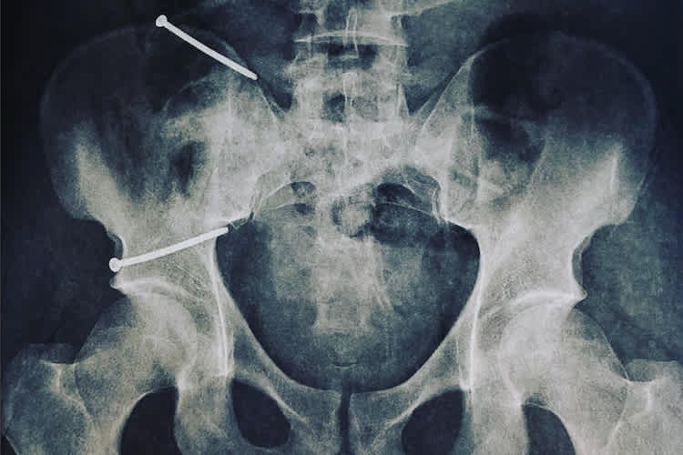 Der Riss in Dominique Aegerters Beckenschaufel wurde fixiert