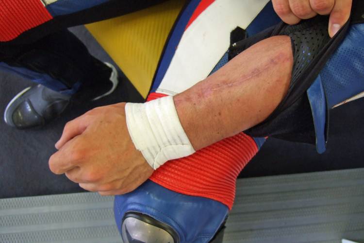 Philippes Arm hat auch schon bessere Zeiten gesehen