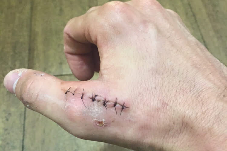 So sah Aleix Espargarós Daumen am Mittwoch vor dem Mugello-GP aus