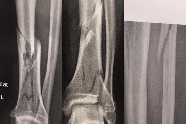 Das war mal ein Unterschenkel