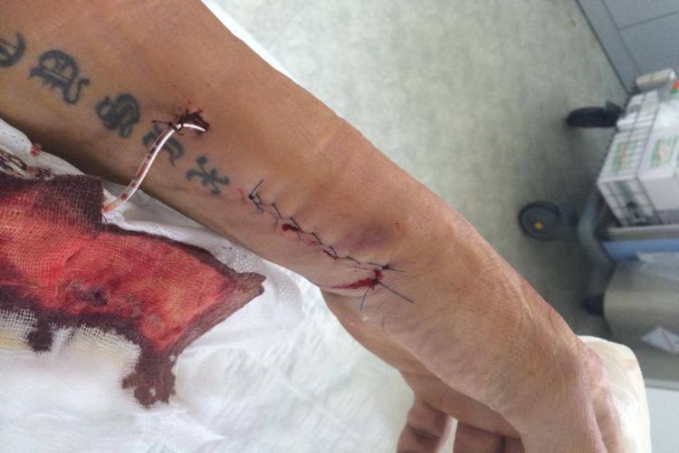 Jakub Smrz nach der Operation