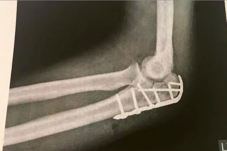 Der Ellbogen von Bastien Mackels