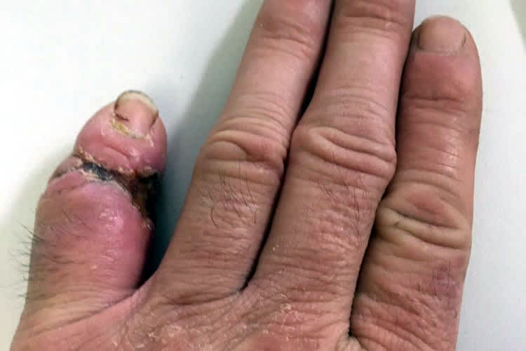 Jörg Teucherts Finger sieht echt übel aus