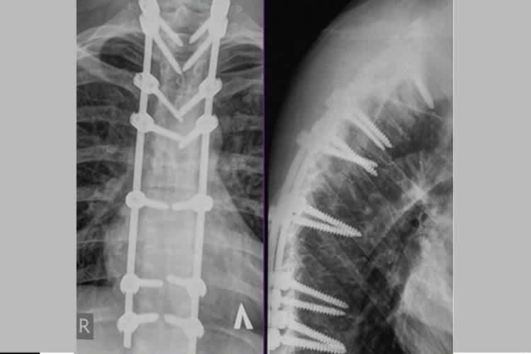 Das Röntgenbild von Tonkovs verletzter Wirbelsäule
