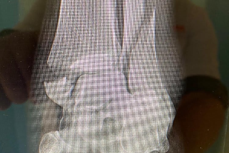 Der Bruch im linken Bein vor