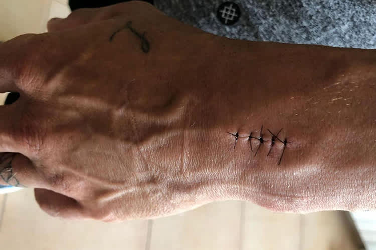 Fünf Tage vor dem Rennen wurde Crutchlow operiert