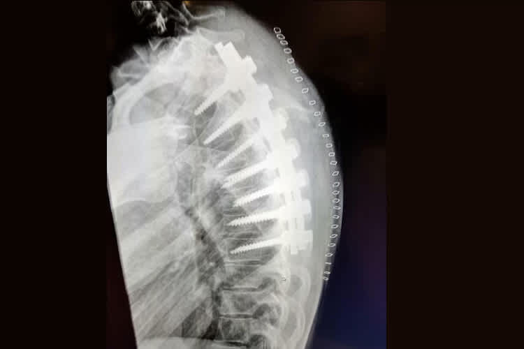 Sieben Wirbel wurden bei Ana Carrasco miteinander versteift