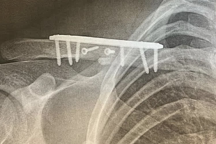 Das Schlüsselbein von Isak Gifting wurde mit Metallplatten und Schrauben fixiert