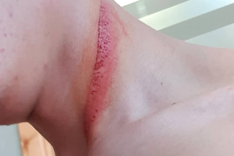 Die Spuren der Bremsscheibe am Hals von Deniz Öncü