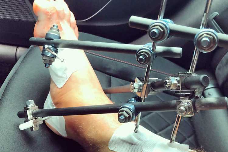 Stichs Fuss in Einzelteilen