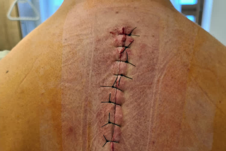 Ein neuer Reissverschluss am Rücken