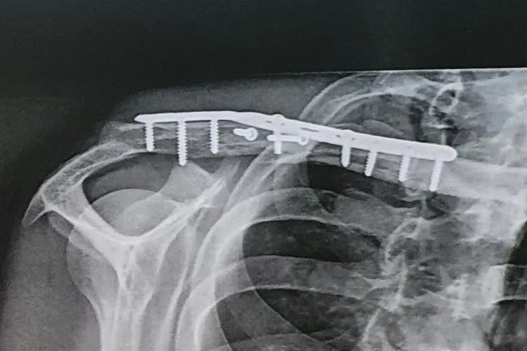 Das zertrümmerte Schlüsselbein nach der OP