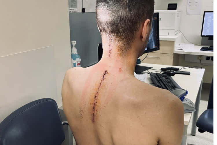 Michael Sandner nach der OP