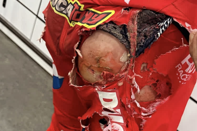 Die Brandwunden von Antonio Cairoli nach seinem Crash in Spring Creek