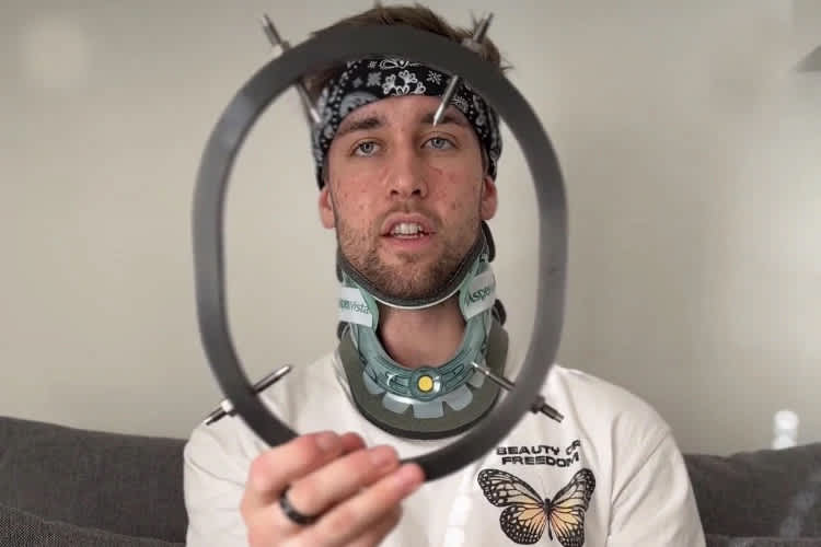 Marcel Stauffer: Nach 12 Wochen durfte der Fixateur weg.