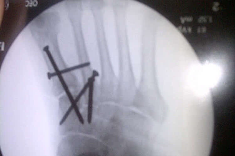 Kenan Sofuoglus rechter Fuss