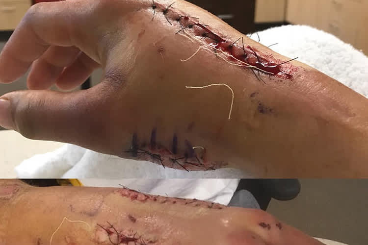 Ken Roczens rechte Hand wurde übel lädiert