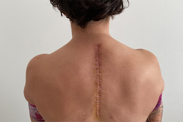 Ana Carrascos Rücken